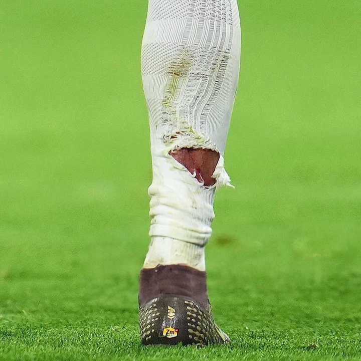 app下载-有点狠！塔蹬踏姆巴佩小腿染黄，姆巴佩小腿袜被踩破露出血痕